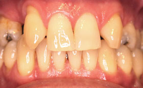 11after