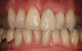 12before