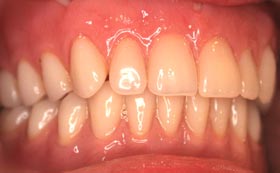 Bocclusion before
