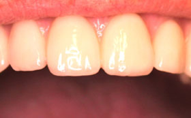 Full upper arch before