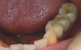 Implant bridge before