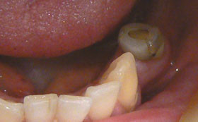 Implant bridge after