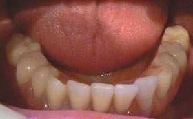 Lower implant before