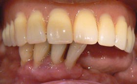 Lower implant after