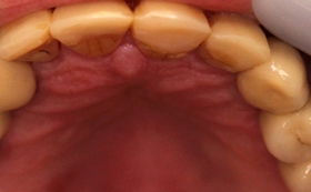 Occlusal before