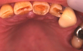 Occlusal after